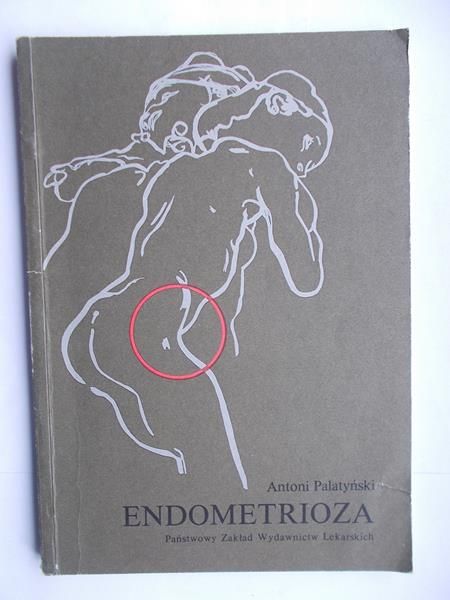 Endometrioza